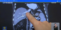 Bỏ rượu không chỉ là quyết tâm đầu năm: Tỷ lệ sống sót của bệnh nhân ung thư gan phụ thuộc vào việc “cai rượu” hoàn toàn